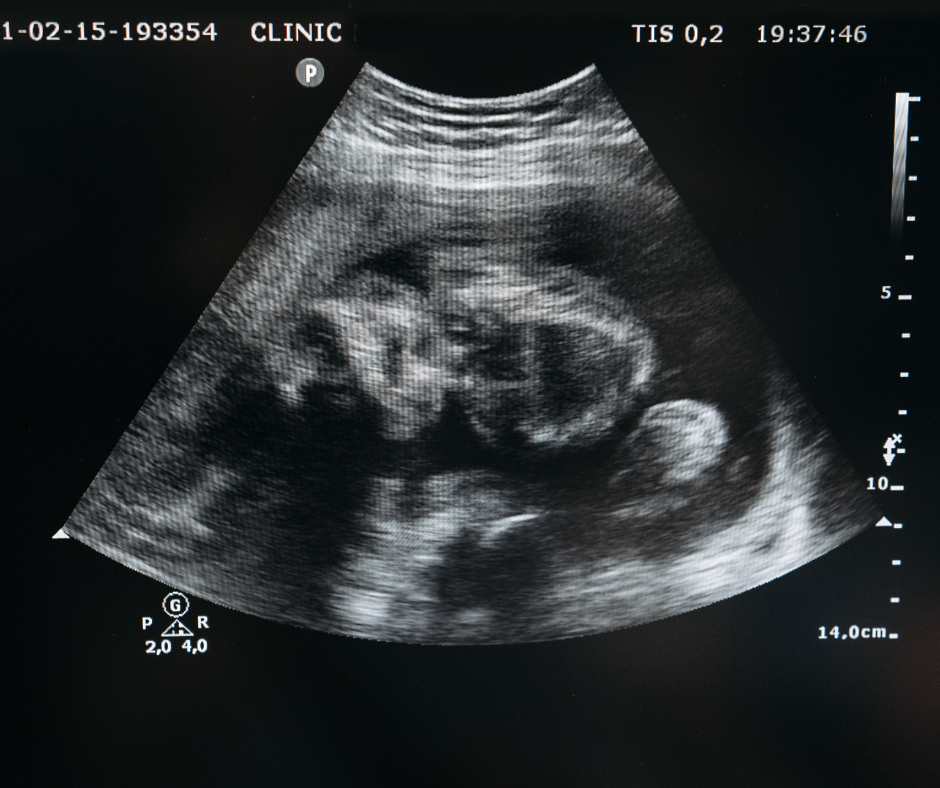 A 12 week scan picture shows a healthy growing baby from the ultrasound.